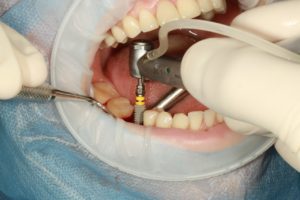 cost-for-dental-implant-surgery-in-mumbai