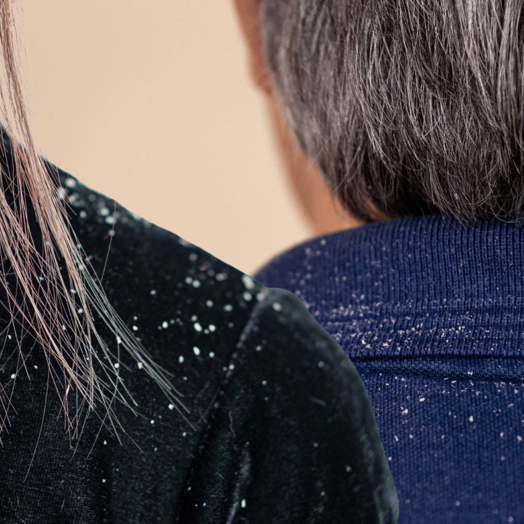 Hard-Water-Softener-reduce-Hair-Fall-Dandruff-improve-Skin-Health-dandruff-treatment-at-home-1